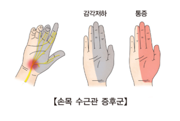 손목터널증후군
