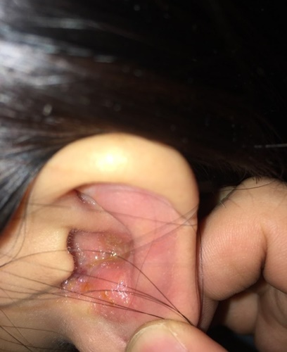 귀 대상포진 증상 후유증