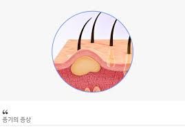 종기가 생기는 이유