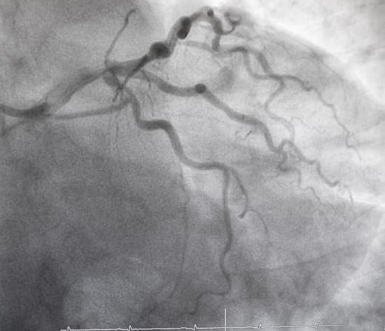 심혈관 조영술(Coronary Angiography): 절차, 목적 및 회복 과정