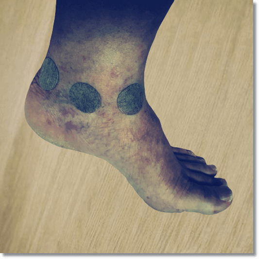 당뇨발 초기 증상