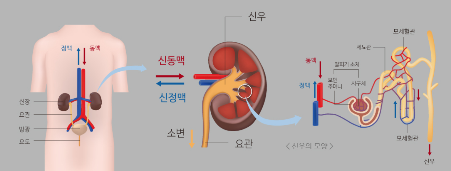 신장 투석 생존기간