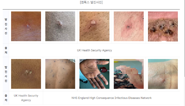 엠폭스 발진사진