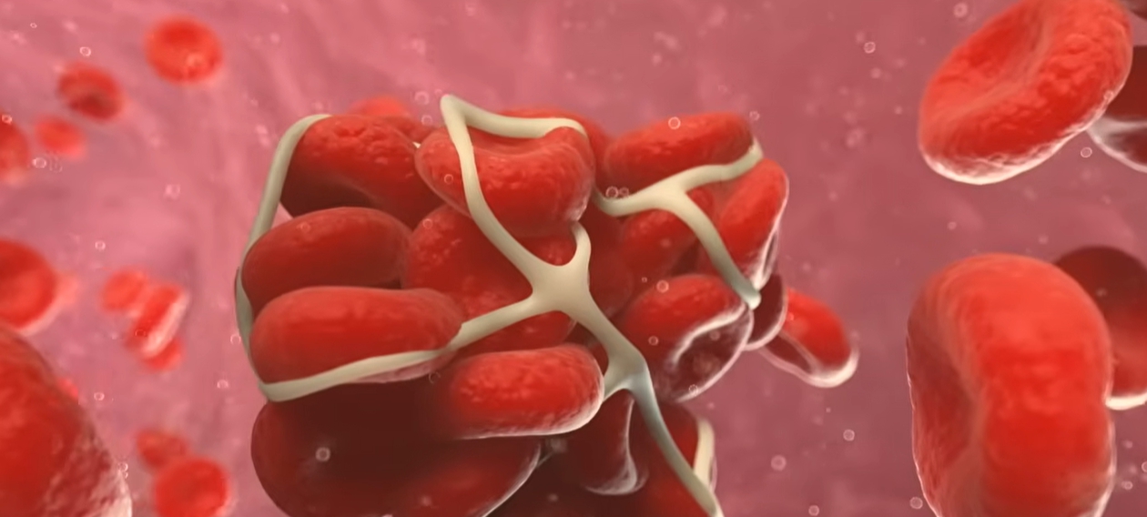 뇌경색 전조증상