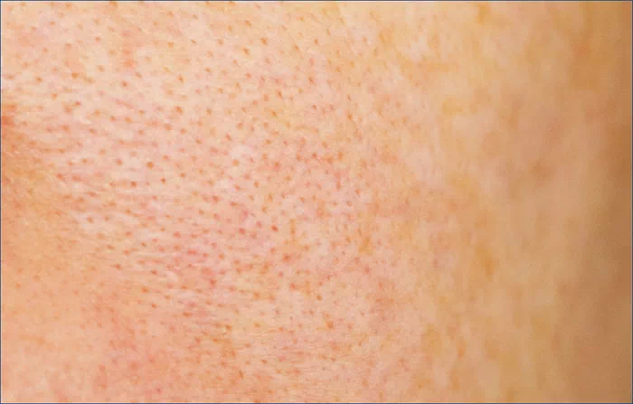 피부 모공각화증