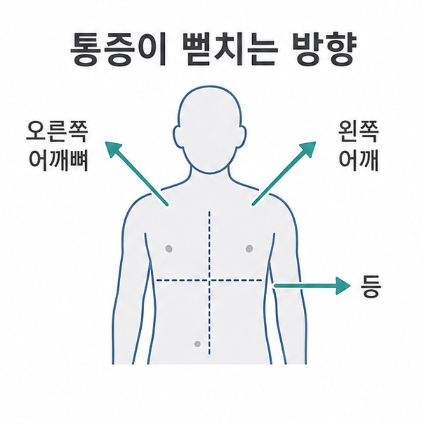 복통이 뻗치는 방향 도해, 오른쪽 어깨뼈와 왼쪽 어깨, 등으로 통증이 번지는 경로를 표시한 그림