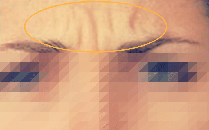 미간-보톡스-시술-전-미간-주름이-심한-여성