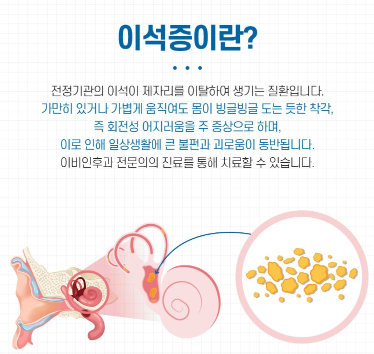 이석증