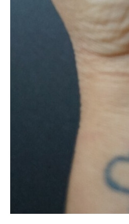 손가락수포대처법