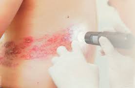 대상포진 초기증상