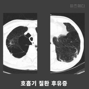 제한성 환기장애