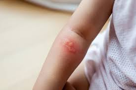 화상 물집 치료방법