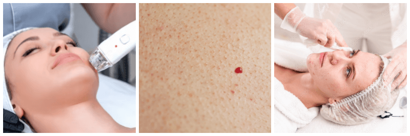 레이저치료사진, 체리혈관종 사진