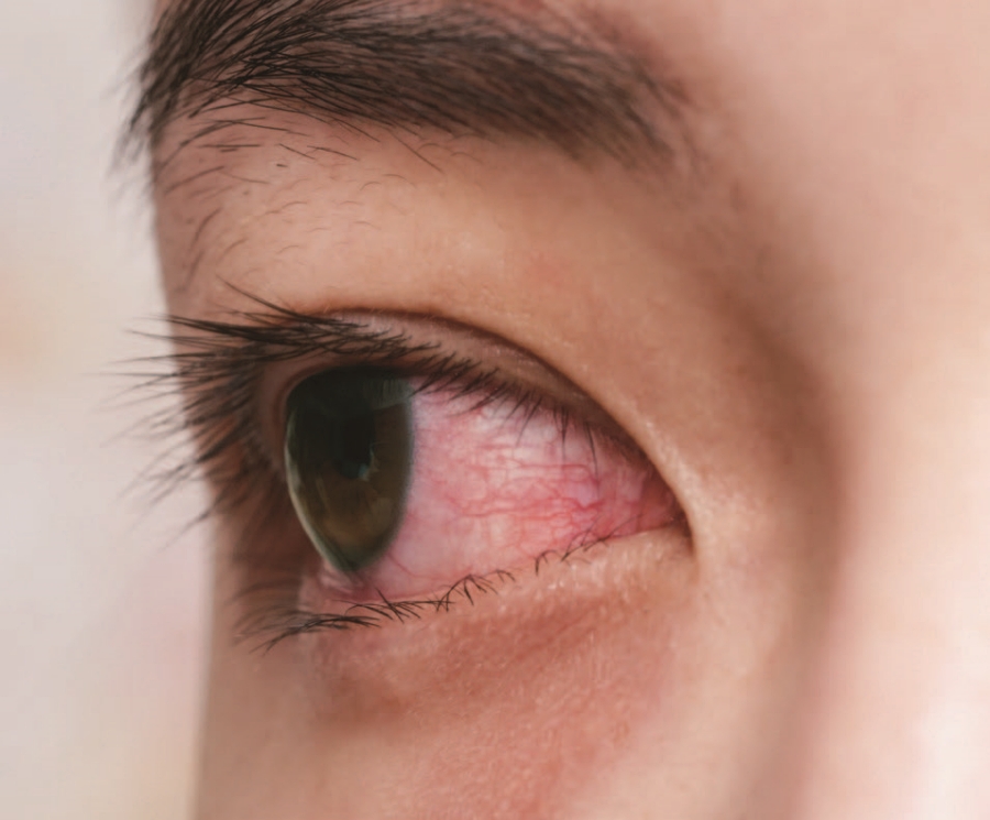 녹내장 초기증상