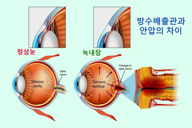 녹내장과 안압