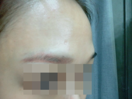 이마 미간 보톡스 후기3