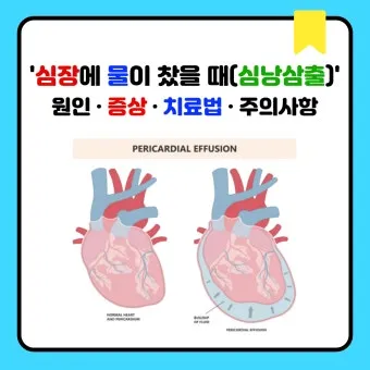 심장에 물이 차는 이유와 관련 질병_5