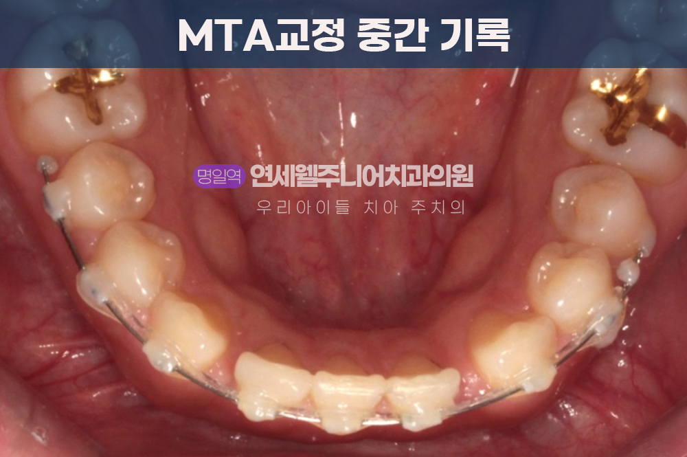 치아 이동 중 촬영한 중간 기록