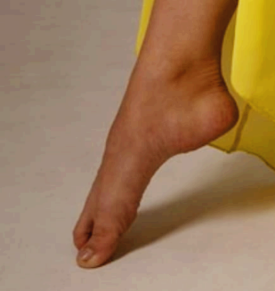복숭아뼈 주위가 부어요, 단순한 부음일까? 물혹일까?