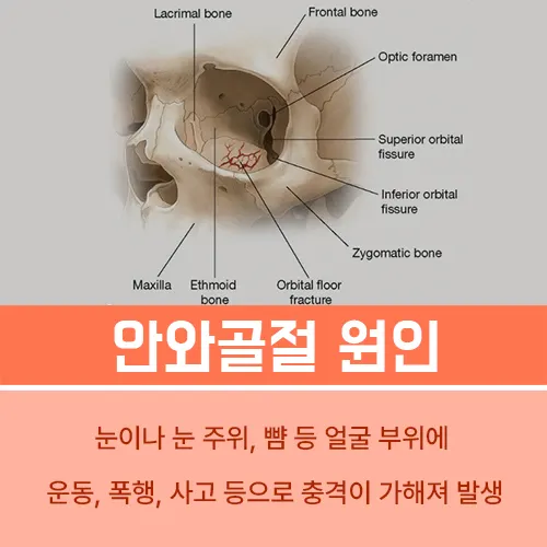 안구함몰