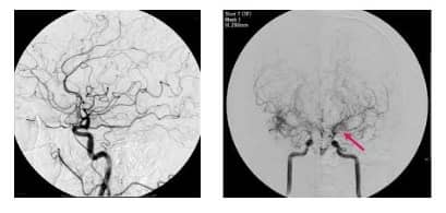 모야모야병 사진