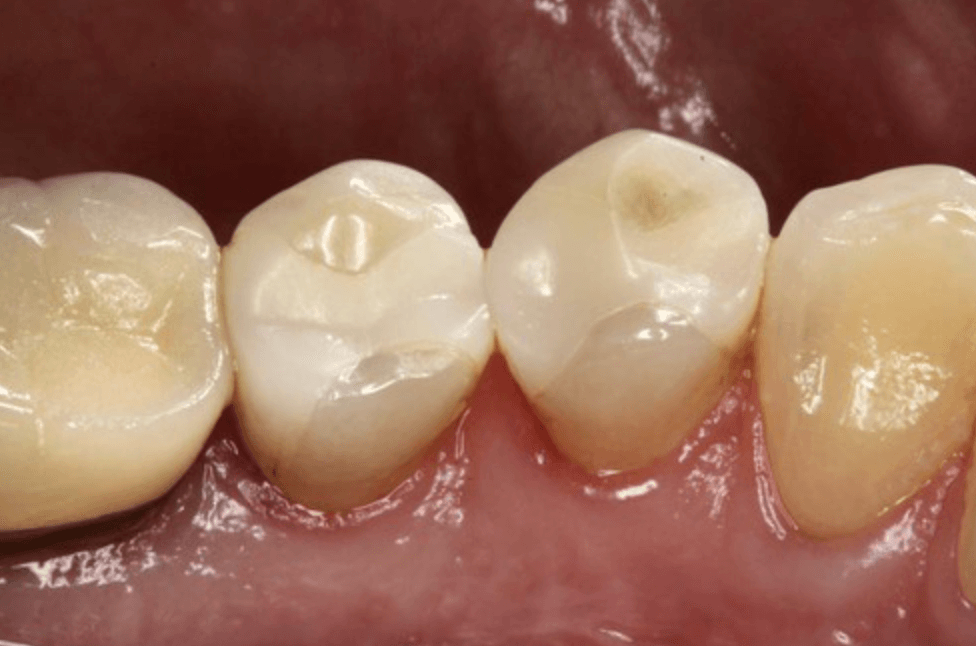 이맥스 세라믹 인레이