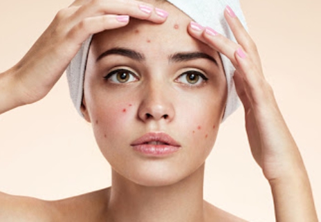 부위별 여드름 원인