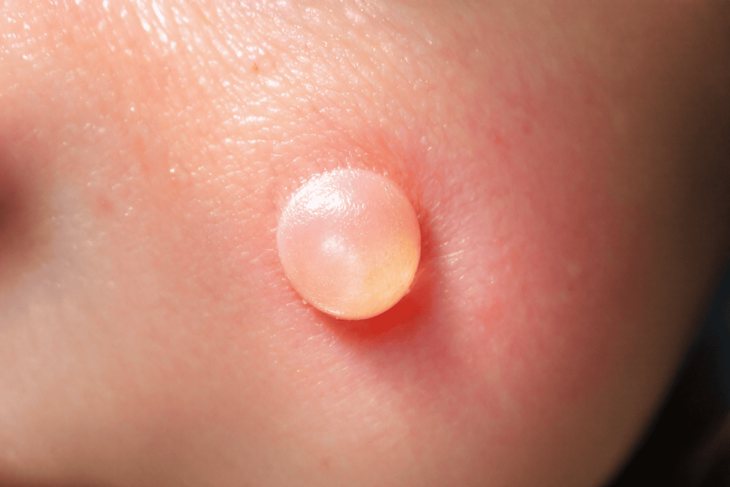 기저세포암 초기증상, 이 신호를 절대 무시하지 마세요