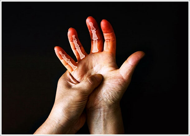 류마티스 관절염 초기증상