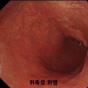 위축성 위염 증상 합병증