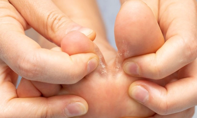 무좀 습진 구별 방법 및 무좀 피부과 비용 정리