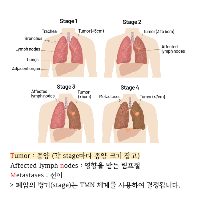 폐암-4기-생존률
