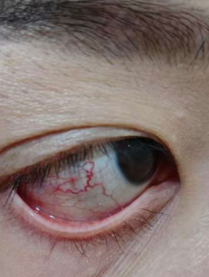 눈이 충혈되고 간지러울 때&amp;#44; 나조린 점안액으로 알러지성 결막염 치료할 수 있어요