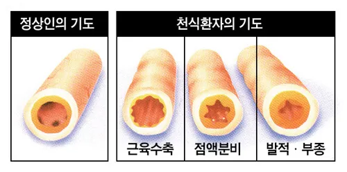 천식 증상