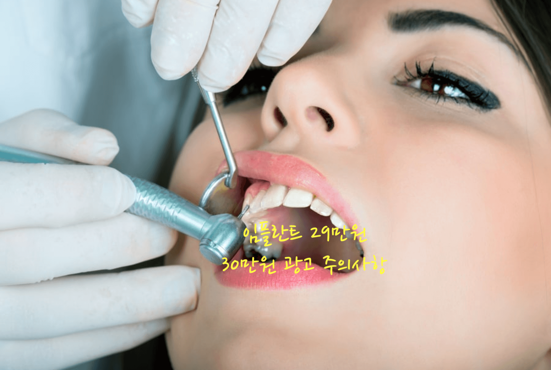 임플란트 29만원