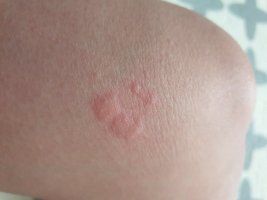 피부 발진 종류