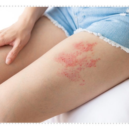 귀 대상포진 증상 후유증