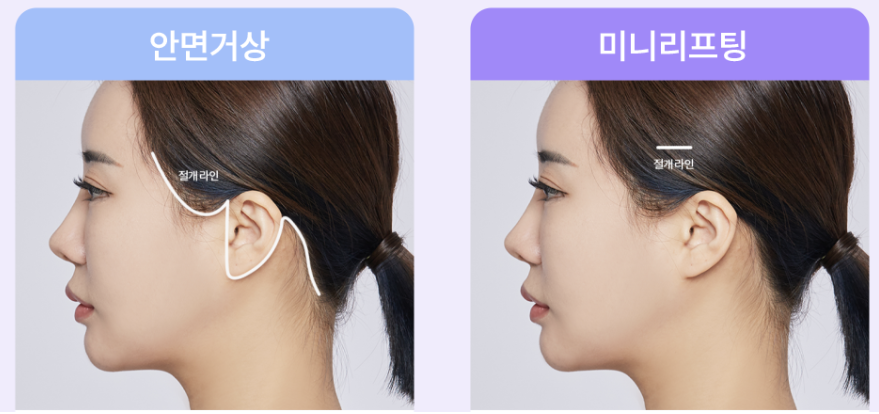 압구정실리프팅, 처진얼굴리프팅