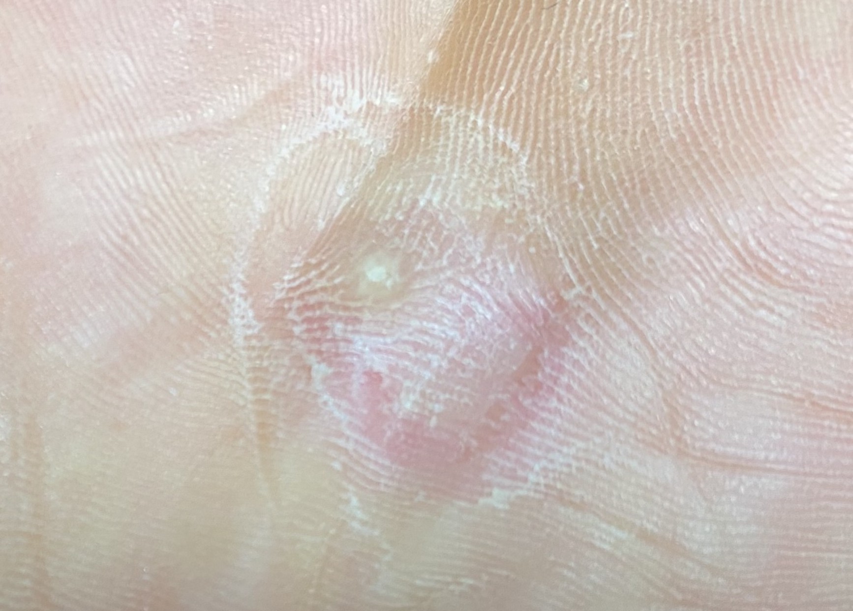 너무 오래하면 안된다 해서 세째날까지만 하고 벗고 발린 모습이에요.