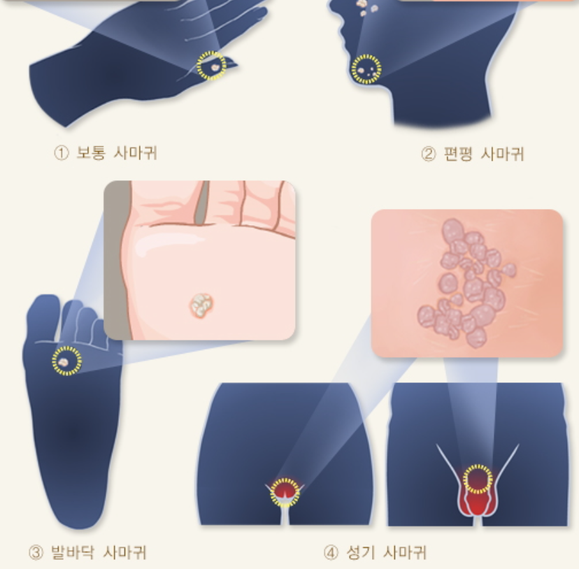 사마귀의 종류