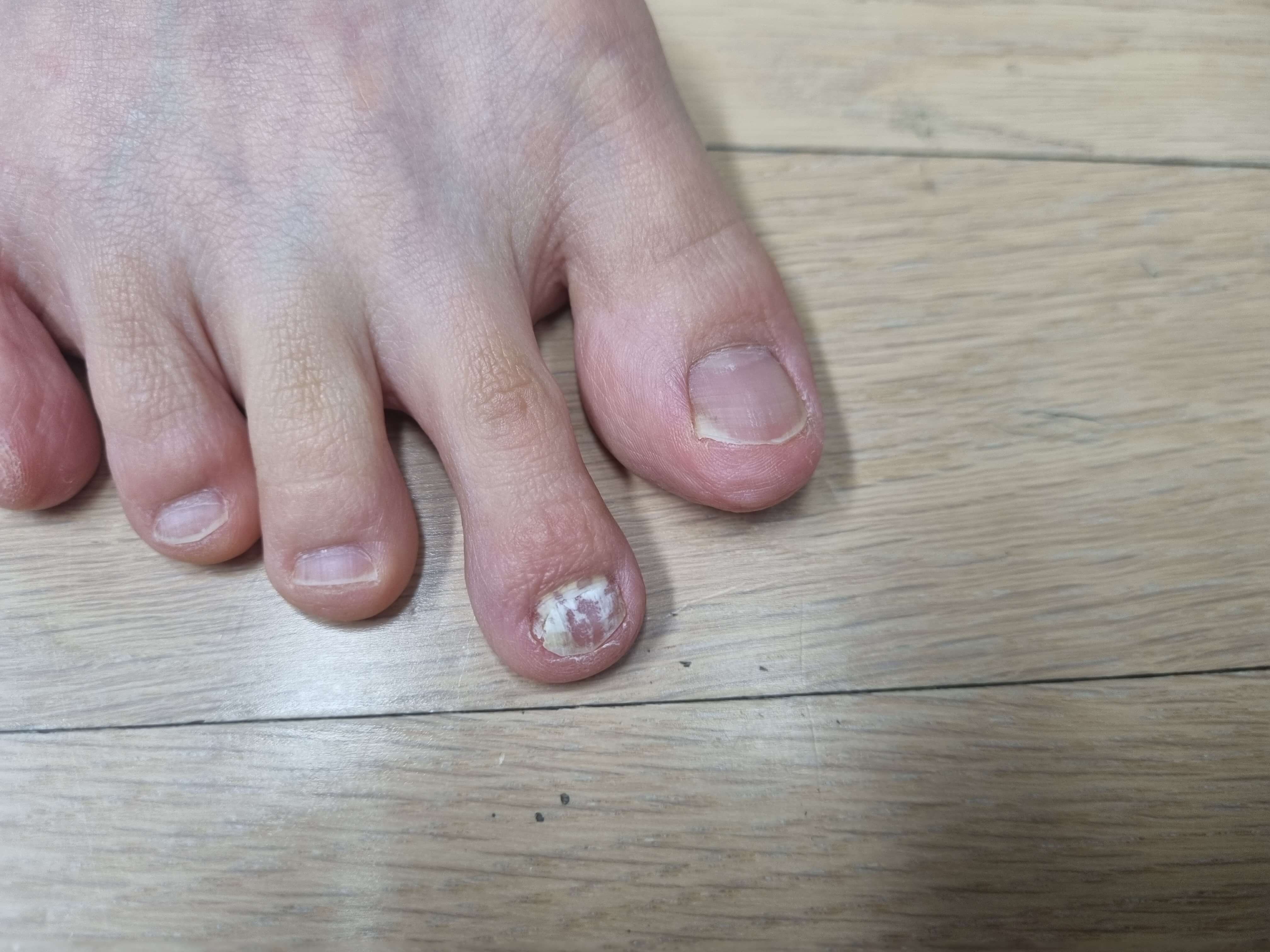 발톱 무좀