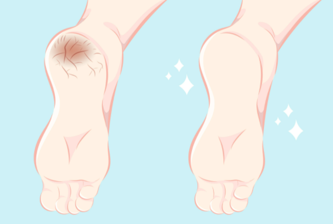 발 뒤꿈치 갈라진 사진