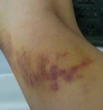 멍든데 바르는 약 연고 BEST 3_22