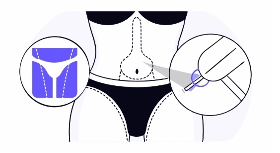 자궁근종 치료 과정