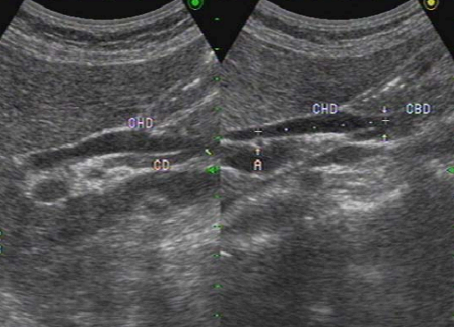 extrahepatic bile duct