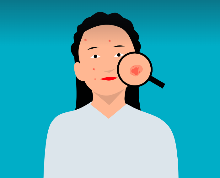 여드름 압출 후 흉터 없이 관리하는 법 관련 사진