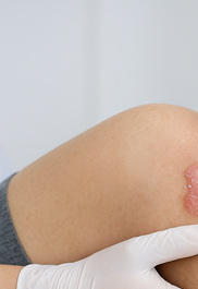 건선 피부염 완전정리