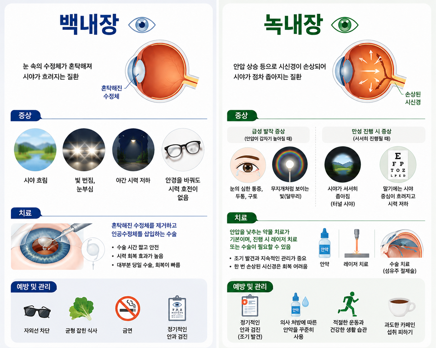 백내장과 녹내장의 증상 이미지