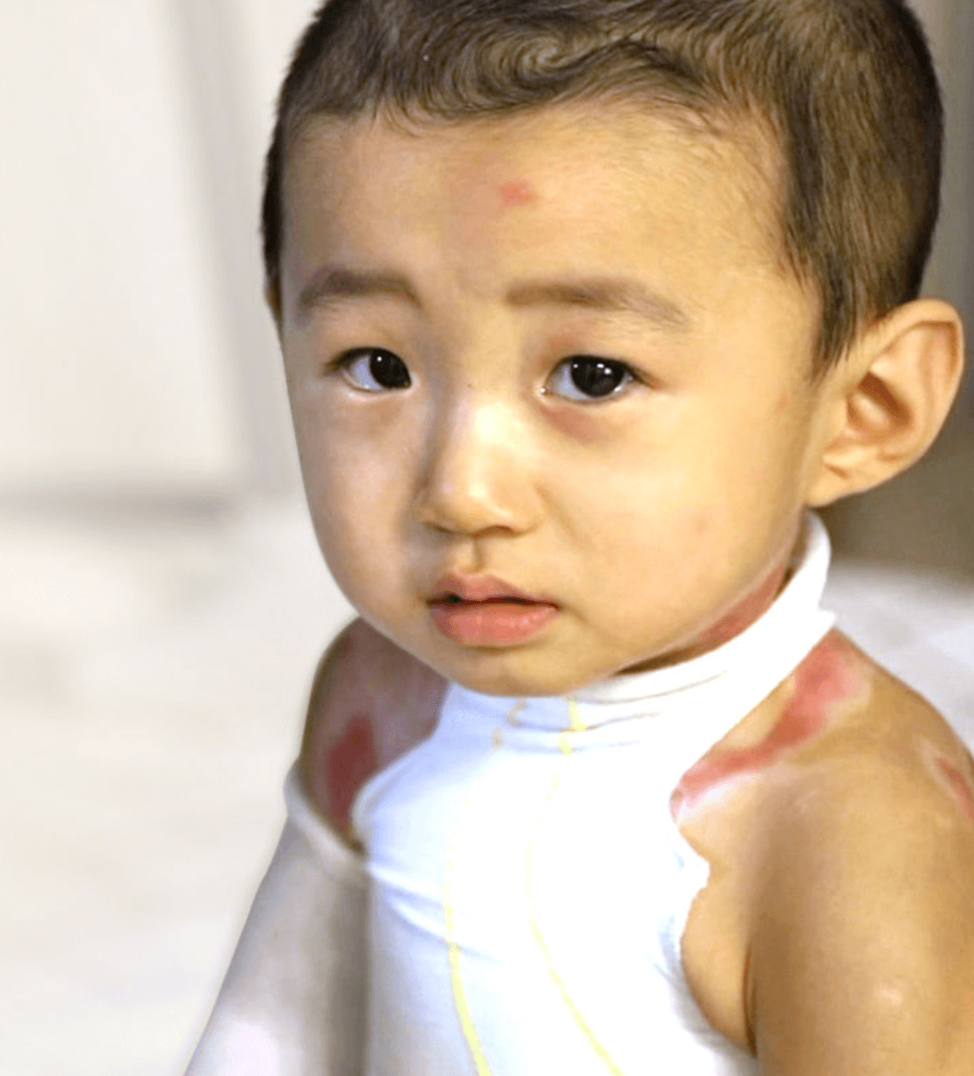 화상 흉터로 가득한 은우의 고통 썸네일