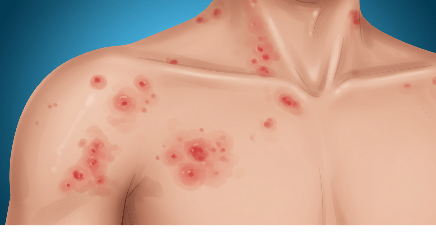 베트남 홍역 유행 지역과 홍역 증상